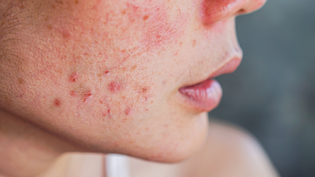 Skincare sob medida para peles sensíveis: ingredientes para buscar (e evitar)