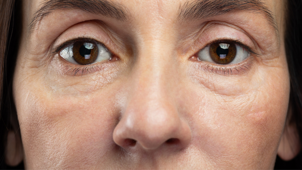 Hidratação e cuidado da região dos olhos: como ela ajuda a reduzir olheiras e bolsas