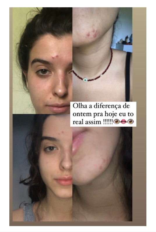 Sérum Facial Anti Acne Natural