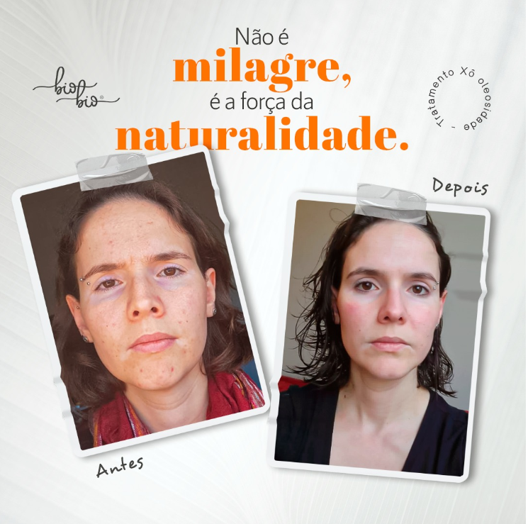 Sérum Facial Anti Acne Natural